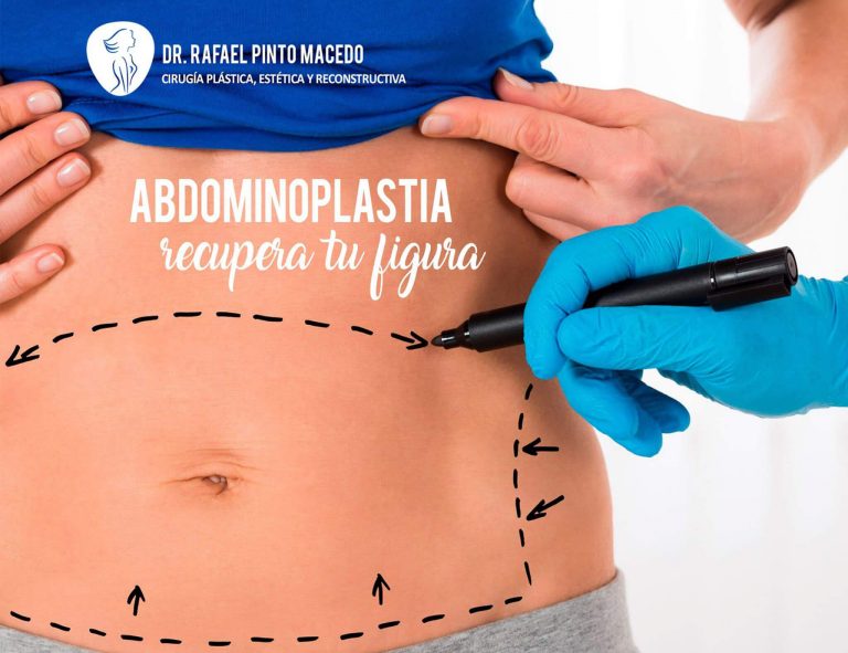 Abdominoplastía en Santiago de Chile - Dr. Rafael Pinto